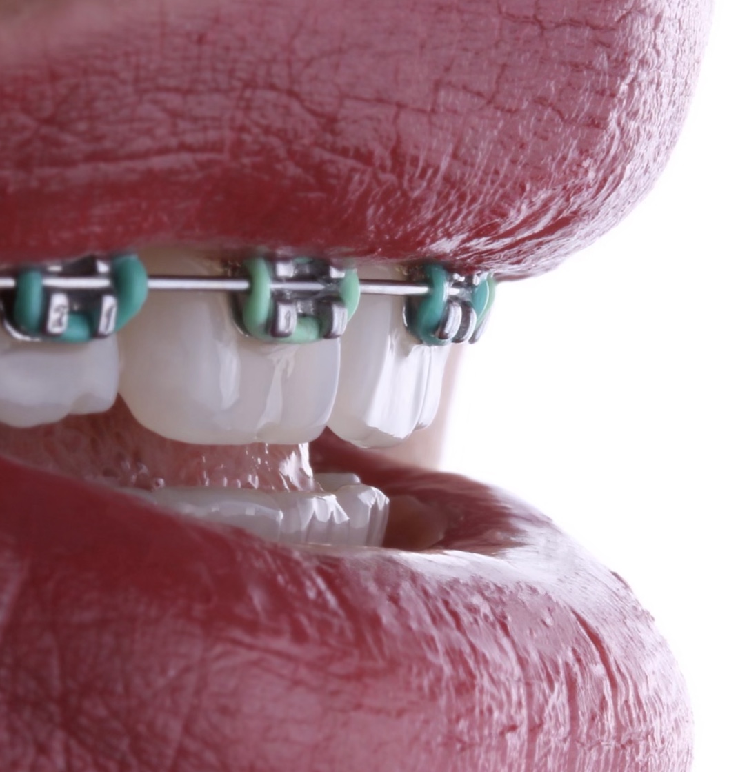 Patient receiving clear aligners