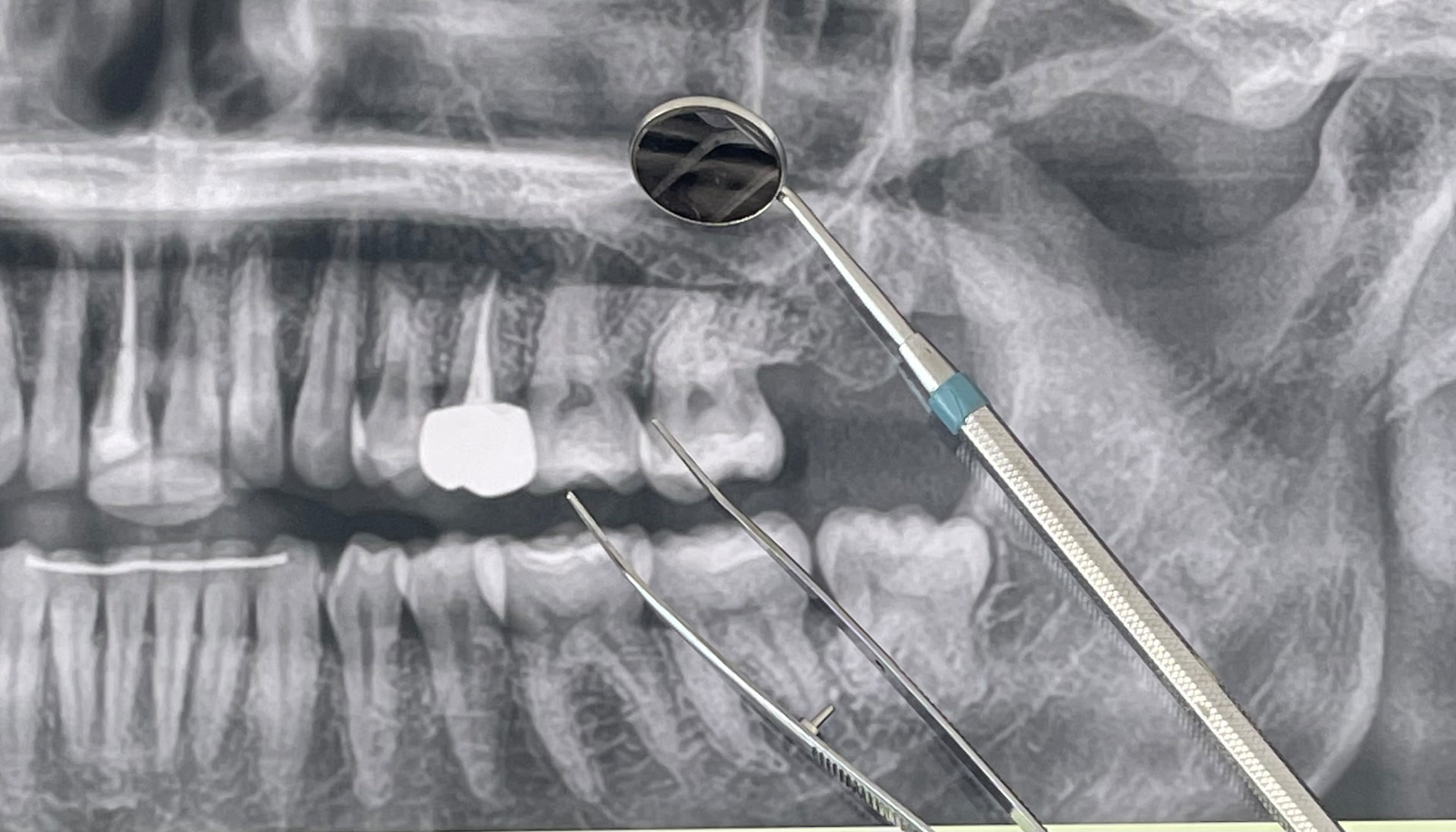 Dentist examining tooth with mirror