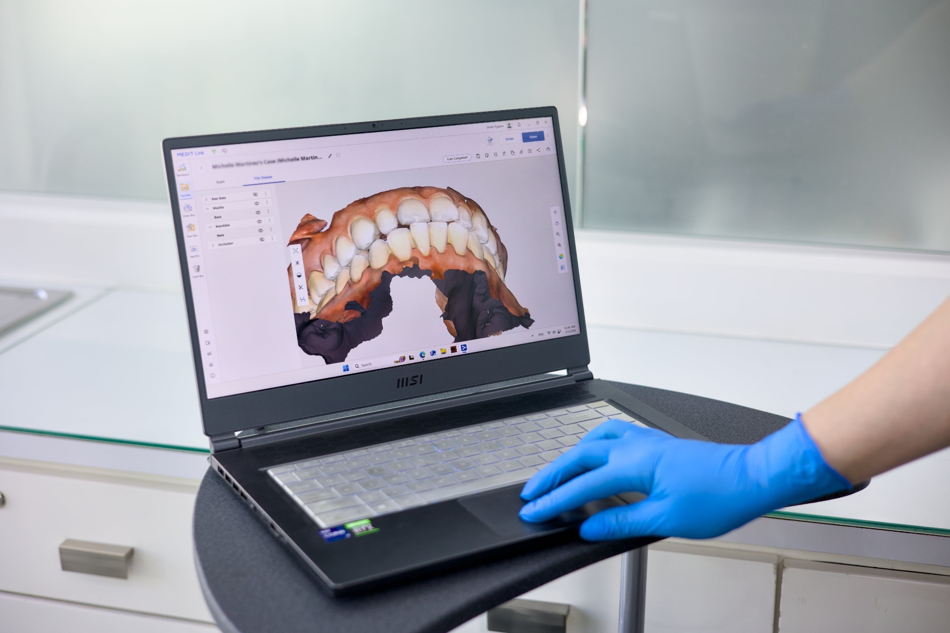 MSI laptop showing a 3D digital smile design scan at Smile Tijuana