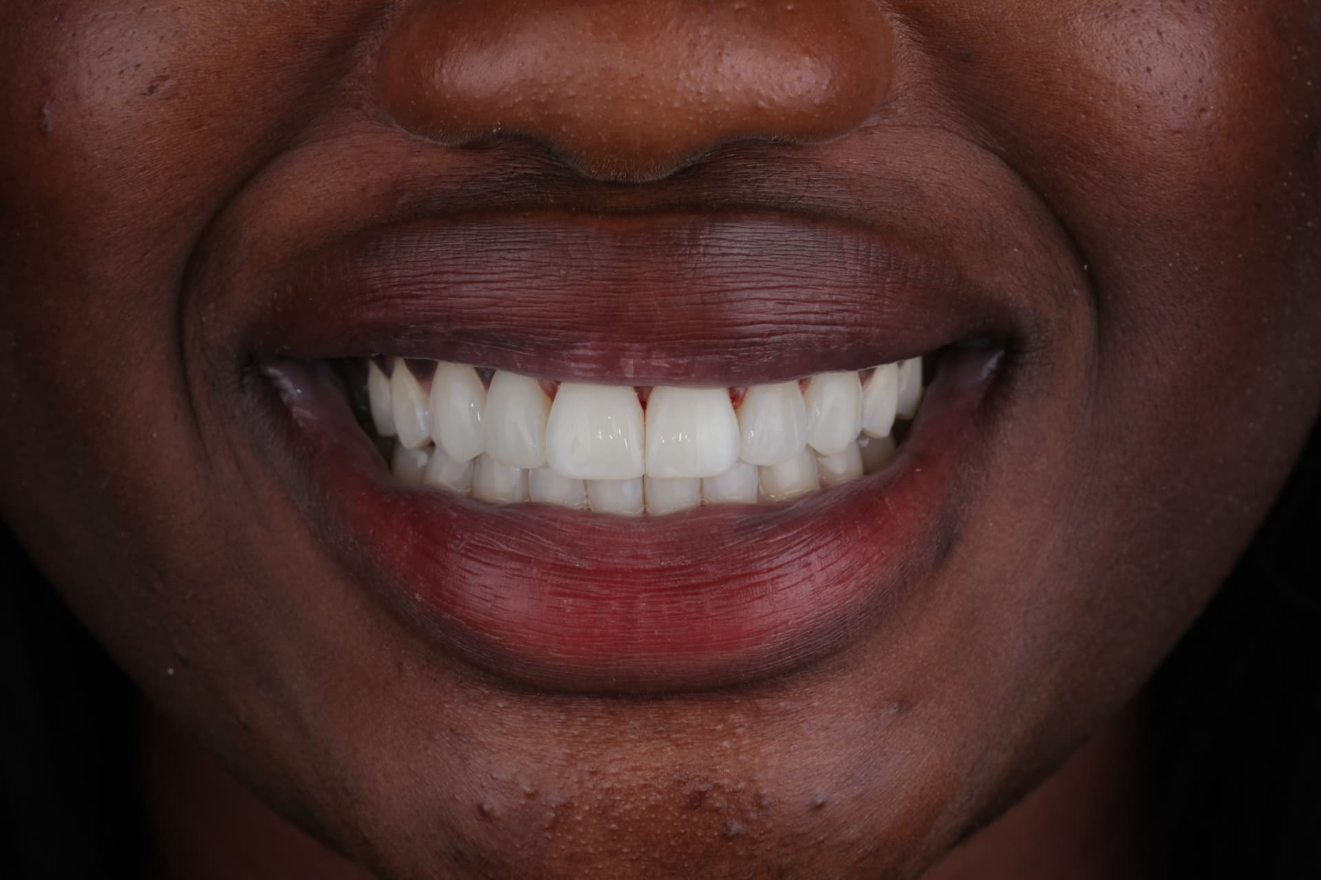 Bright white smile after composite veneers