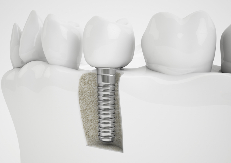 Titanium dental implant held by gloved hand