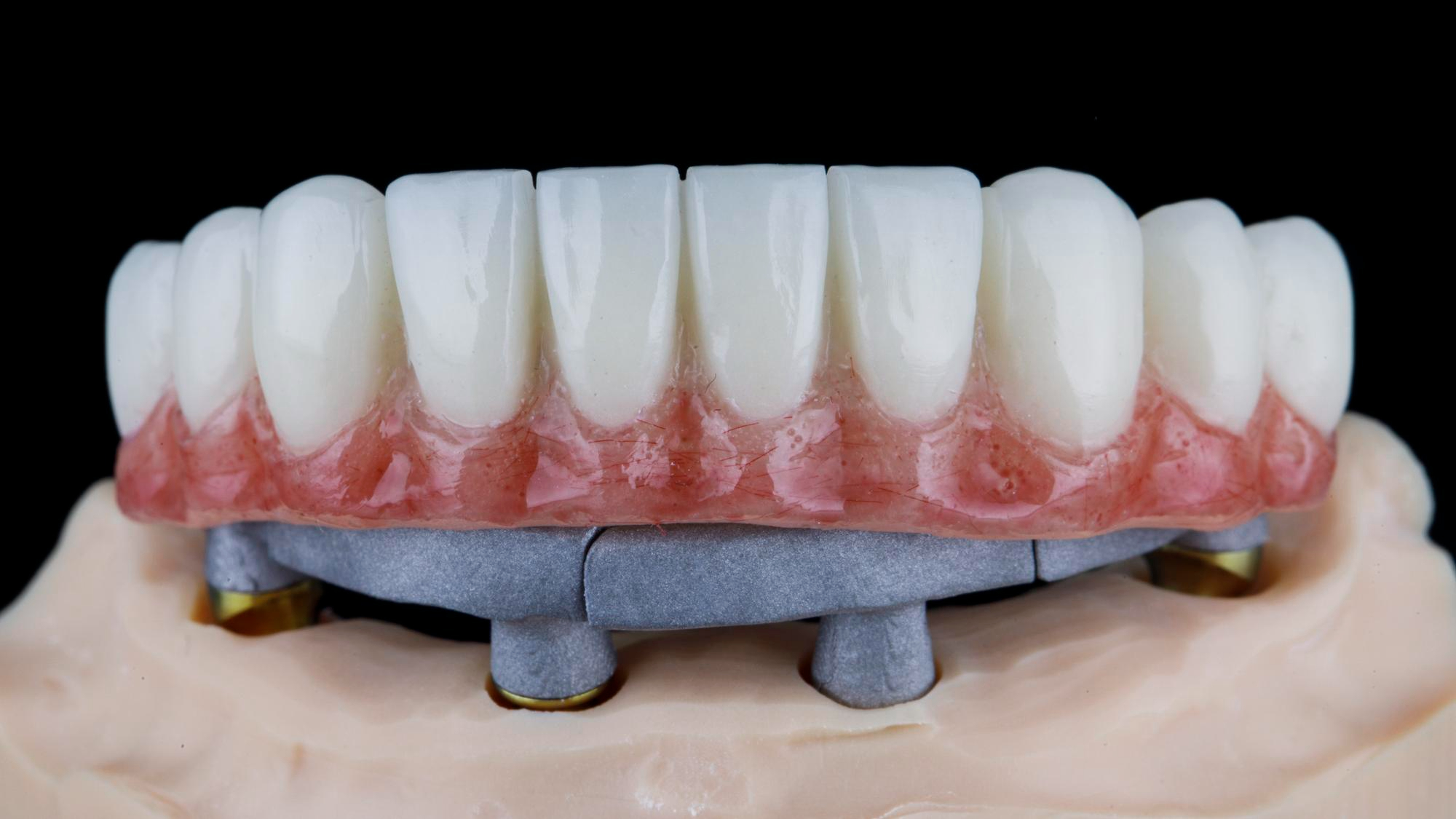 Full-arch dental implants smile