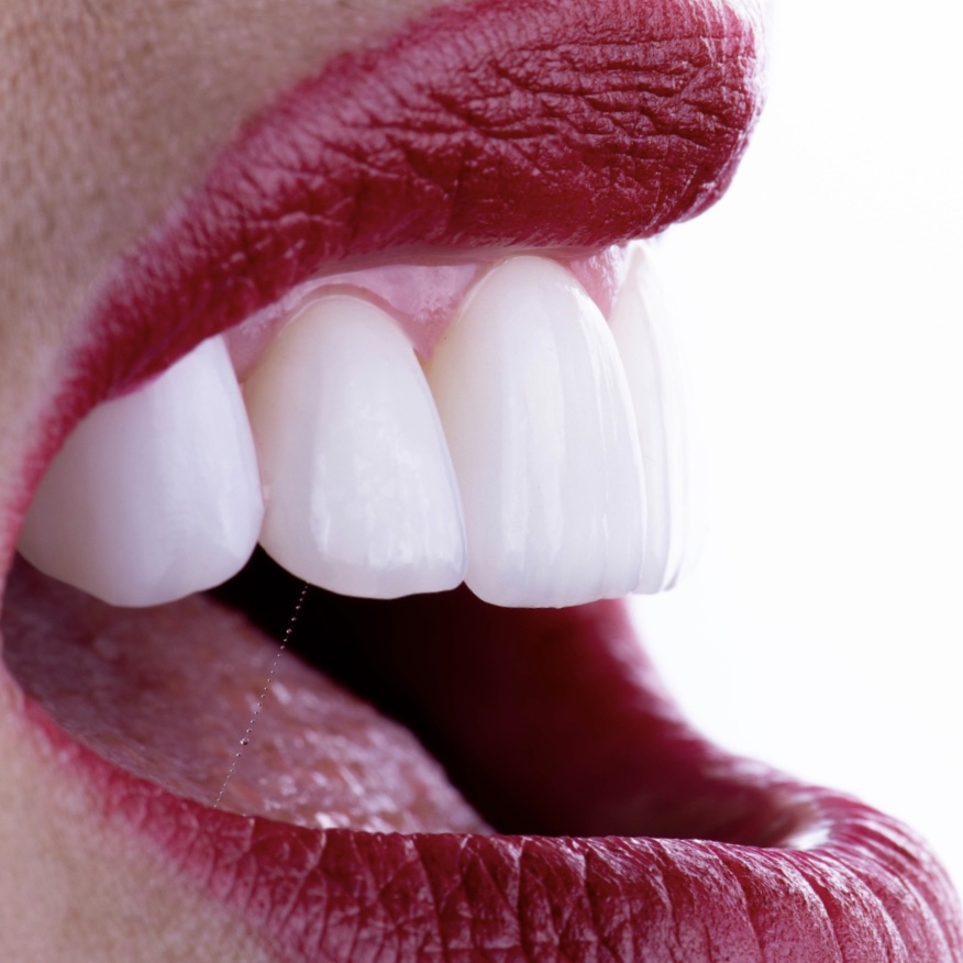 Porcelain veneers being held by a dental technician