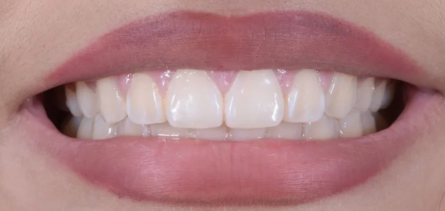 After — Case 6
