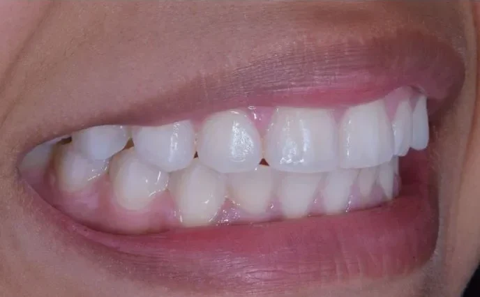 After — Case 21