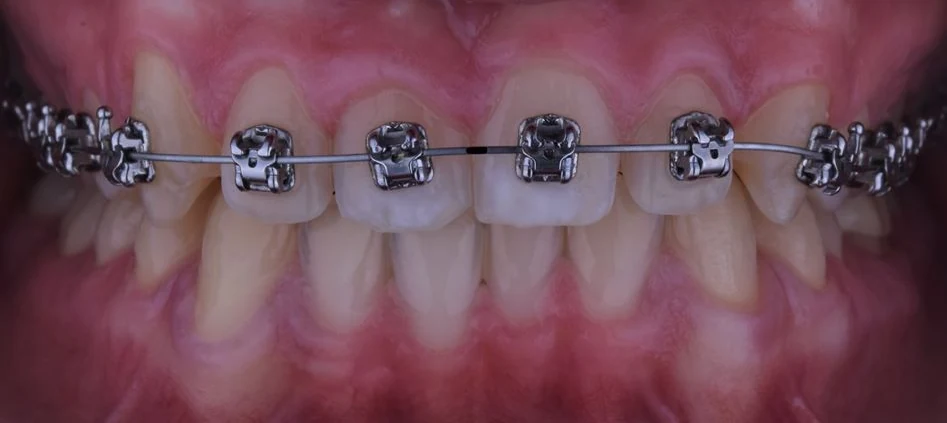 After — Case 13