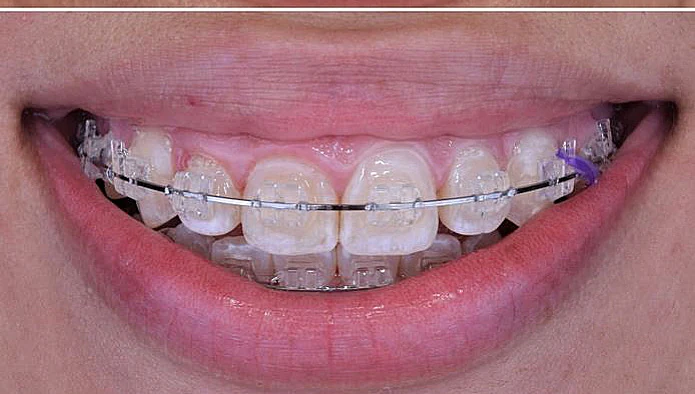 After — Case 14