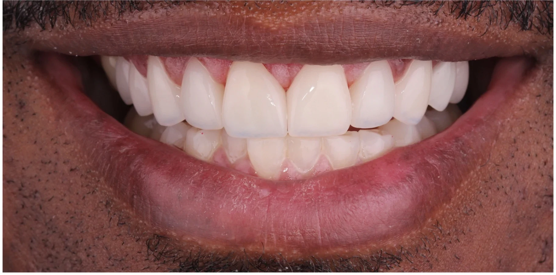 After — Veneers case 1