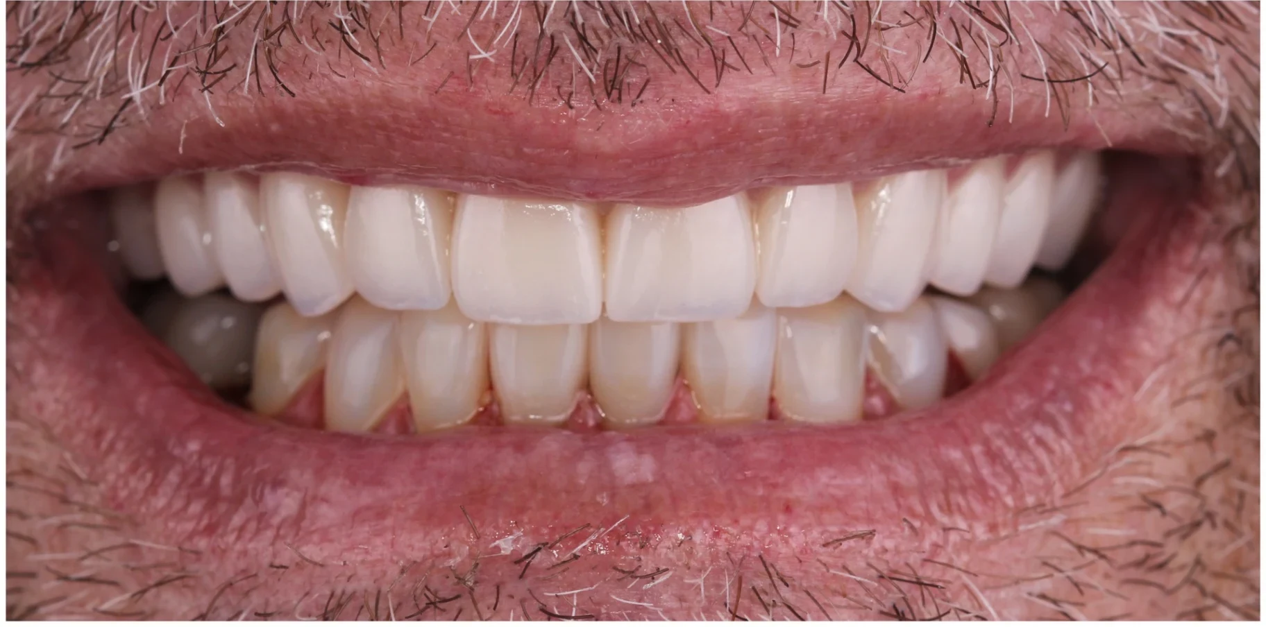 After — Veneers case 2
