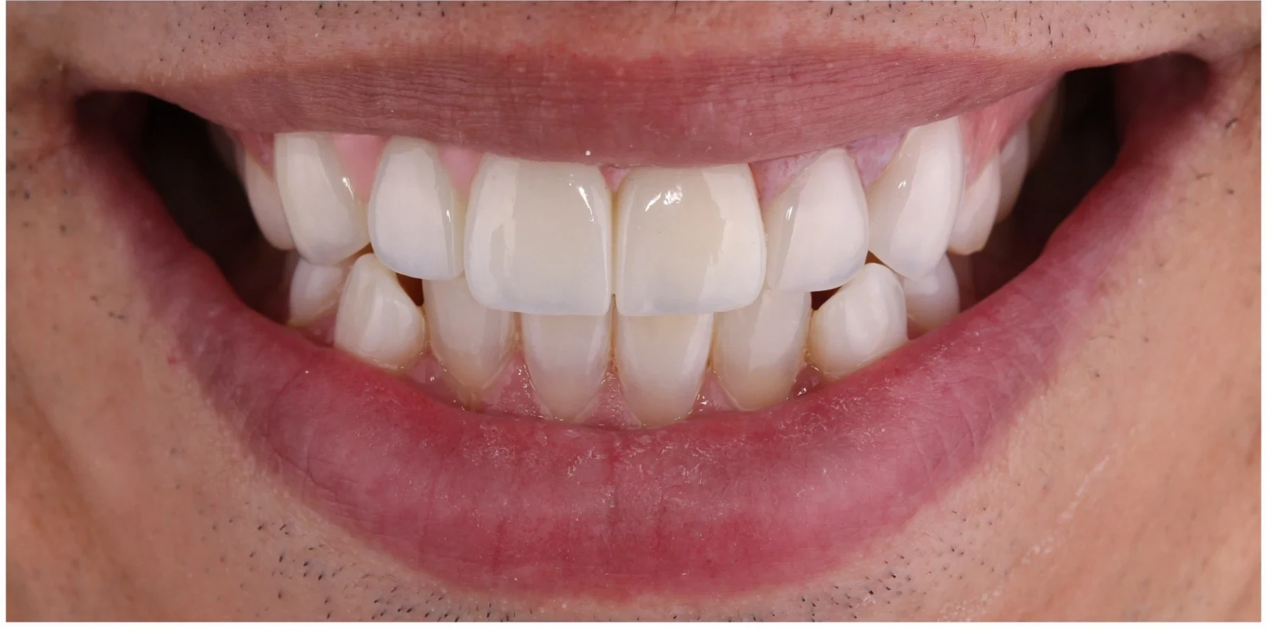 After — Veneers case 3