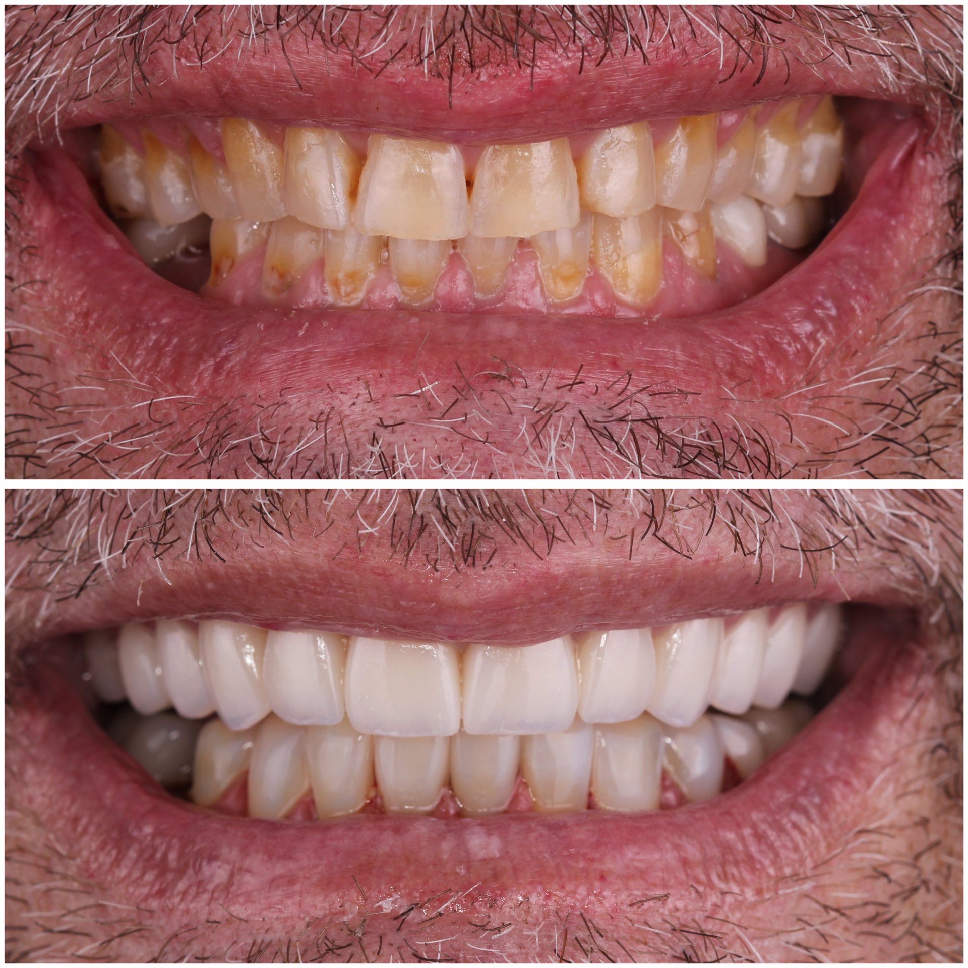 Before and after veneers brightening discolored teeth