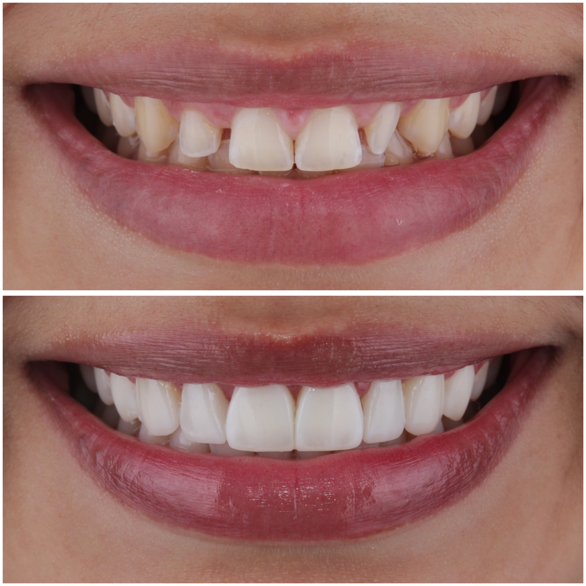Before and after veneers closing small gaps between teeth