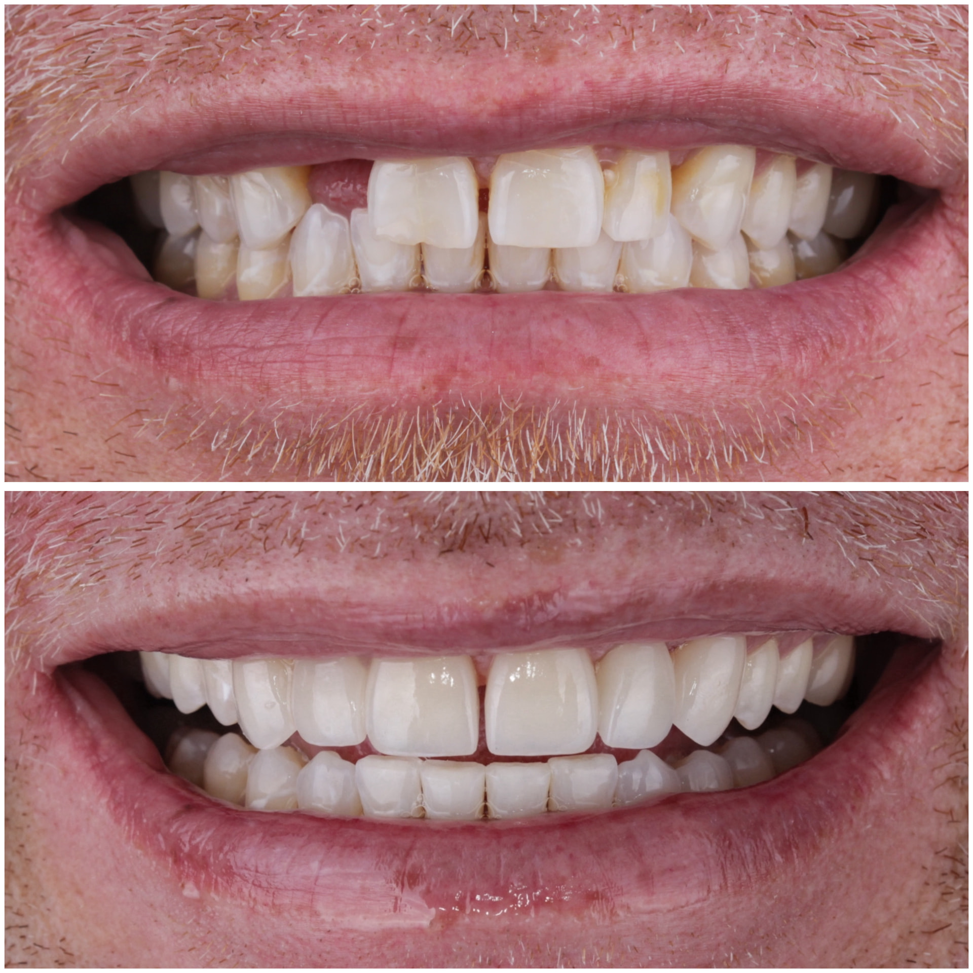Before and after veneers restoring worn and damaged teeth