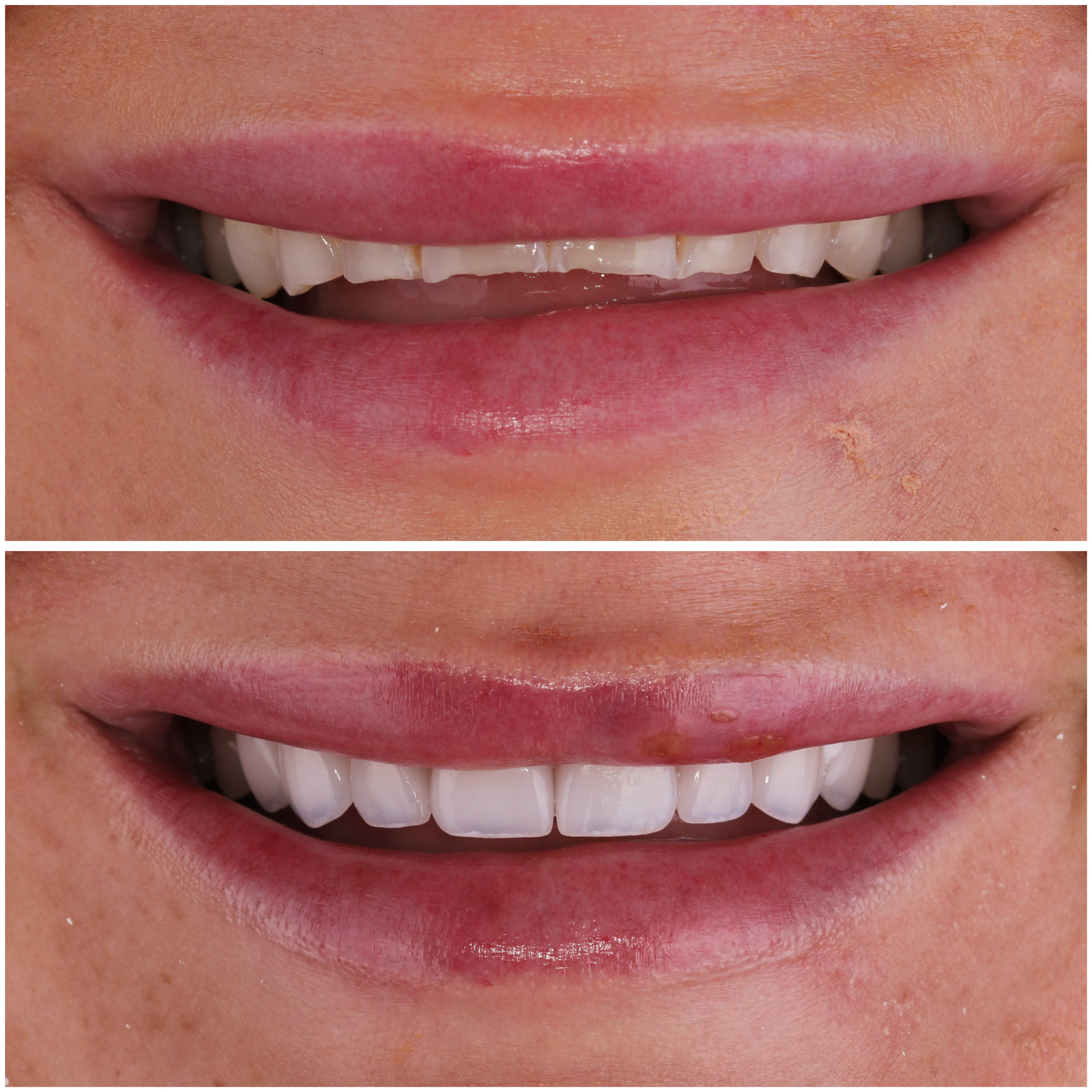 Before and after veneers creating a more symmetrical smile